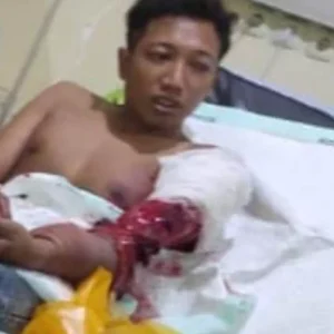 Pekerja Pabrik Triplek di Blitar Alami Kecelakaan Kerja Hingga Cacat Permanen