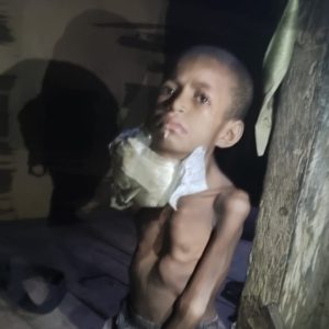 Bocah 4 Tahun Penderita Penyakit Aneh, Benjolan Dileher Segede Kepala