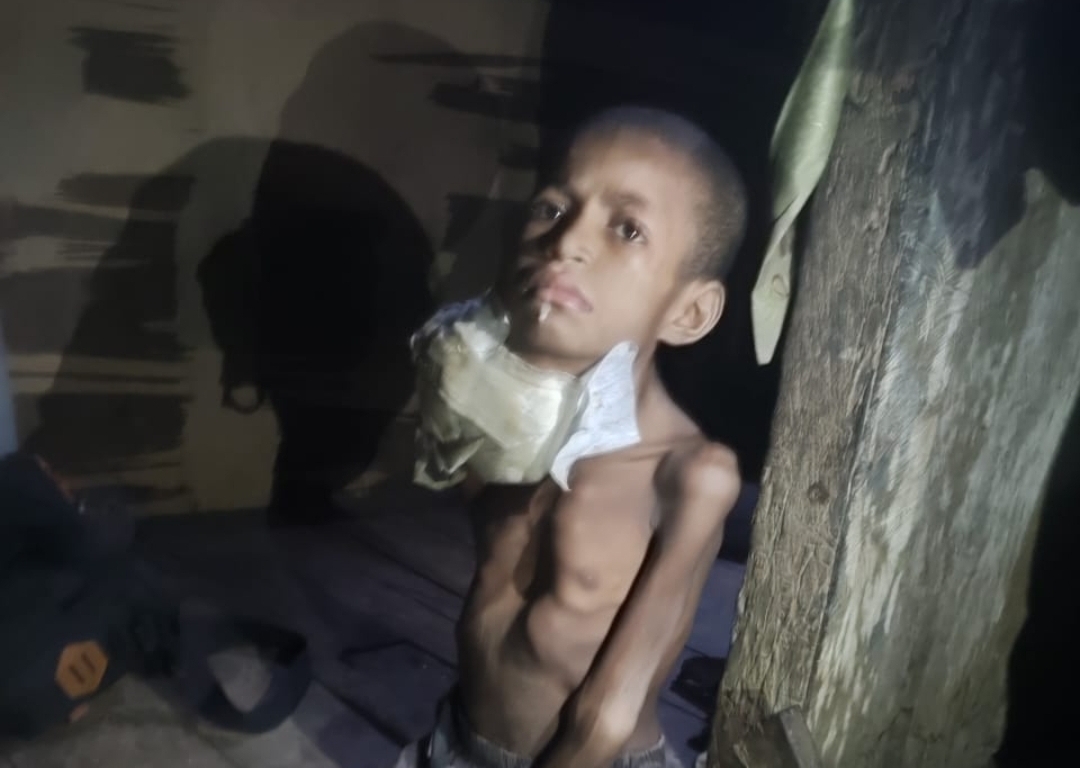 Bocah 4 Tahun Penderita Penyakit Aneh, Benjolan Dileher Segede Kepala