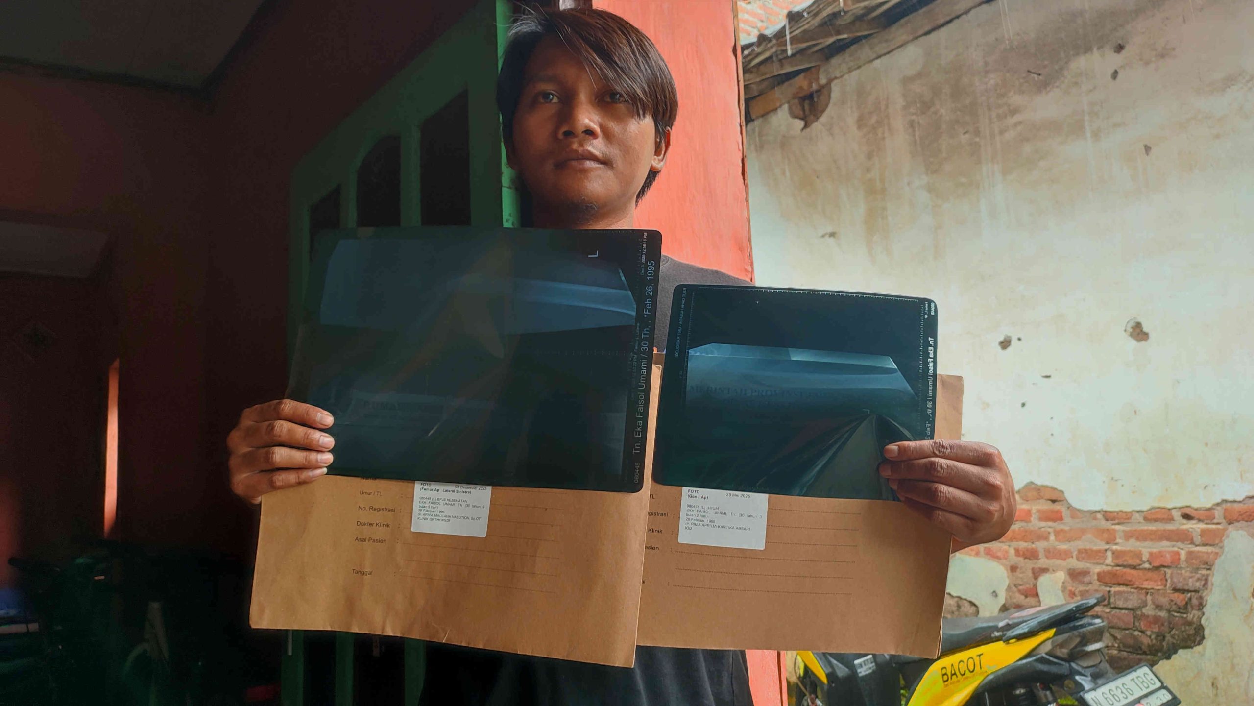 Patah Tulang di Balik Jeruji Lapas II A Kediri: Terpeleset atau Dibanting?